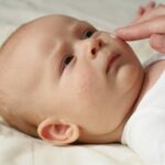 eczema in babies