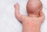 Skin Rashes In Babies – 5 Major Causes & Care Tips To Prevent Them